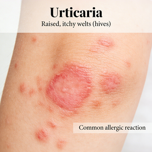 Modelos de urticaria NHP