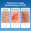 แบบจำลอง Lupus Erythematosus ทางผิวหนังของเมาส์ (CLE)