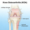نماذج هشاشة العظام في ركبة الجرذ (KOA).