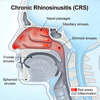 Modelli di rinosinusite cronica nel topo (CRS) e rinite allergica